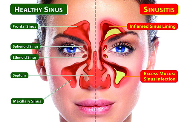 01 25 2017 Straightening Out Your Sinuses